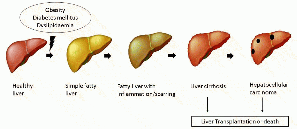 Steatotic Liver Disease