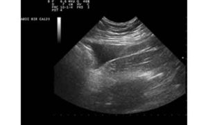 hypertension MASLD MASH