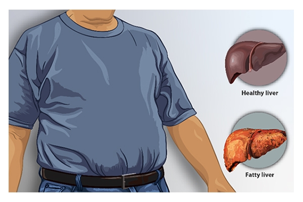 non‑alcoholic fatty liver disease
