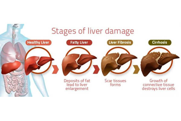 non‑alcoholic fatty liver disease