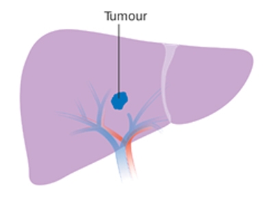 liver cancer