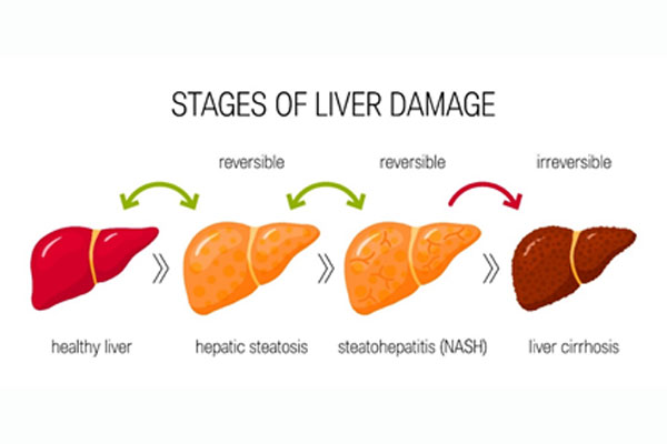 Metabolic dysfunction-Associated Steatohepatitis