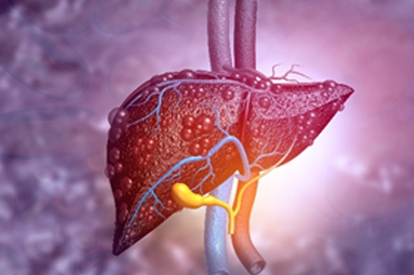 liver cancer stages symptoms