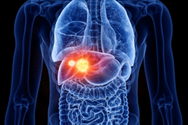 liver cancer stages symptoms