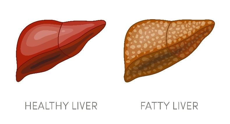 Metabolic dysfunction-Associated Steatohepatitis