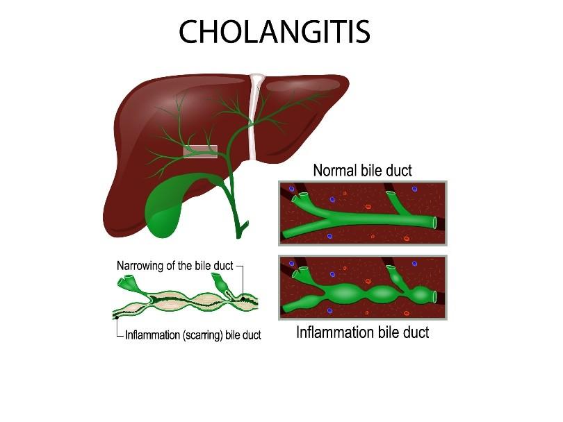 cirrhosis symptoms