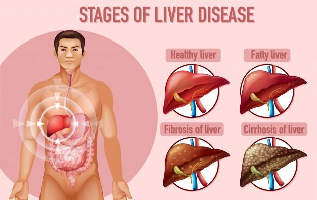 liver cancer