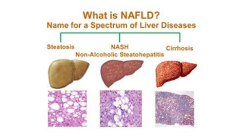 non‑alcoholic fatty liver disease