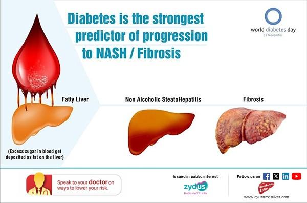 Type 2 diabetes and MASLD