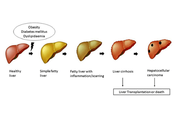 alcoholic liver disease